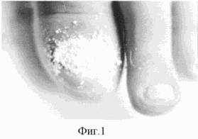 СПОСОБ ЛЕЧЕНИЯ ОНИХОМИКОЗОВ КОМБИНИРОВАННЫМ ПРЕПАРАТОМ