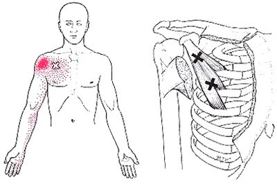 Малая грудная мышца – источник боли, о котором Вы не догадываетесь